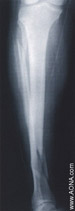 Distal fracture