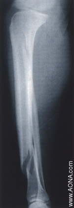 Distal Fracture