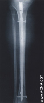 Distal Fracture