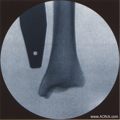 Aligning ruler with physeal scar