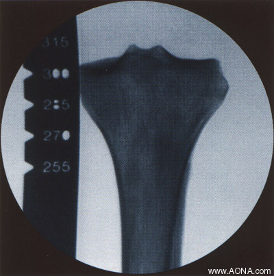 Aligning ruler with physeal scar