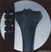 AP image of proximal tibia