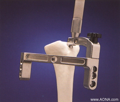 Proximal locking instrumentation assembly