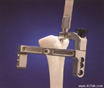 proximal locking instrumentation assembly