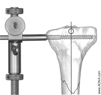 Identify nail entry point