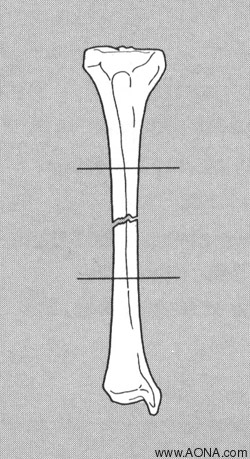 Indications for Conventional Non Locking Technique