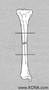 Indications for Conventional Non Locking Technique