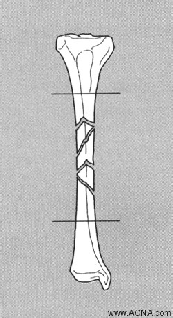 Indications for Locking Technique