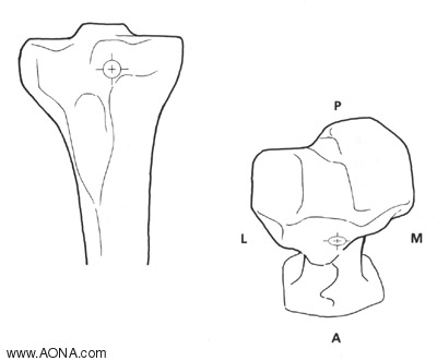 Nail insertion entry point