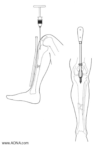 Nail insertion entry point