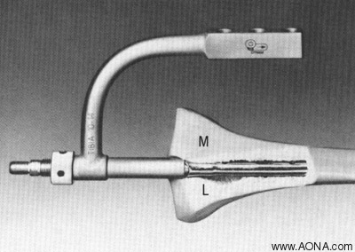 Removing the Threaded Conical Bolt