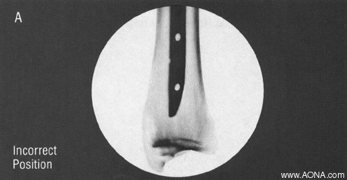 align image intensifier - incorrect position