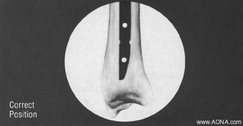 align image intensifier - incorrect position