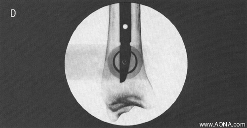 drill through both cortices