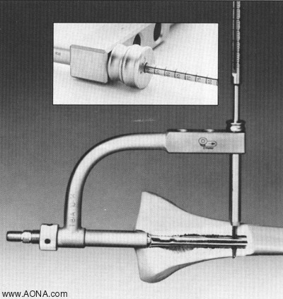 Measure for the proper length 4.9 mm Locking Bolt