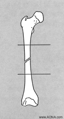 stable diphyseal fractures