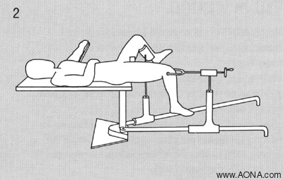 Supine Positioning on a Fracture Table