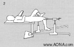 Supine Positioning on a Fracture Table