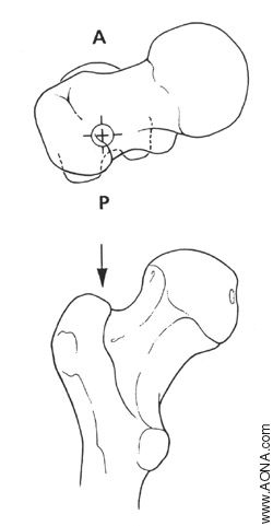 Nail Insertion - Entry Point