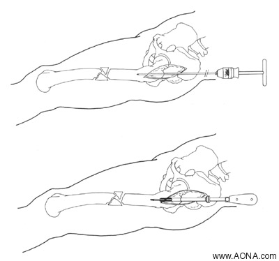 Opening the Medullary Canal