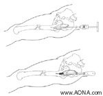 Opening the Medullary Canal