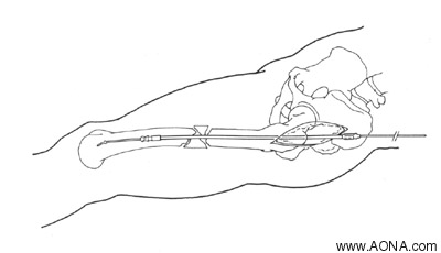 Reaming the Medullary Canal