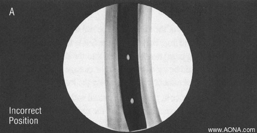 Distal Locking with the Radiolucent Drive - incorrect position