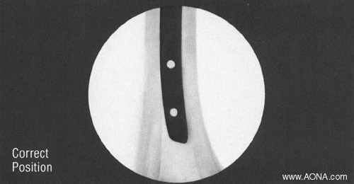 Distal Locking with the Radiolucent Drive - correct position