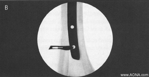 Distal Locking with the Radiolucent Drive - stab incision