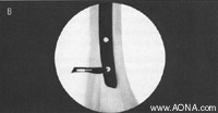 Distal Locking with the Radiolucent Drive - stab incision