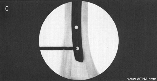 center drill bit in locking hole