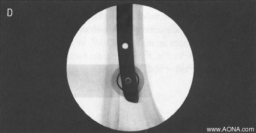 drill through both cortices