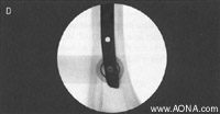 Distal Locking with the Radiolucent Drive
 - drill through both cortices