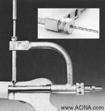 measure for the proper length 4.9 mm Locking Bolt using depth gauge