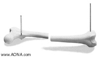 Choose the proper entry point for the nail, and open the
 medullary canal with the 11.0 mm Cannulated Cutter.