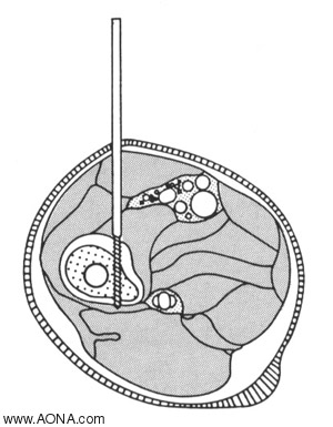 The design of the Curved Aiming Attachment ensures proper positioning of the Schanz screw