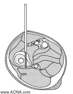 The design of the Curved Aiming Attachment ensures proper positioning of the Schanz screw