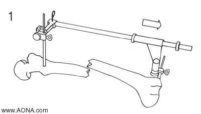 Distraction Loosen the distal Spindle Nut