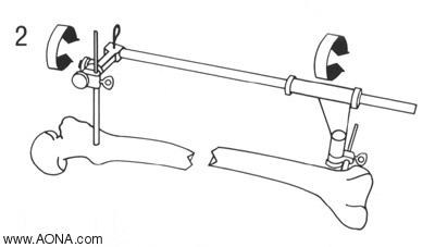 Distraction Loosen the distal Spindle Nut