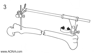 Distraction Loosen the distal Spindle Nut