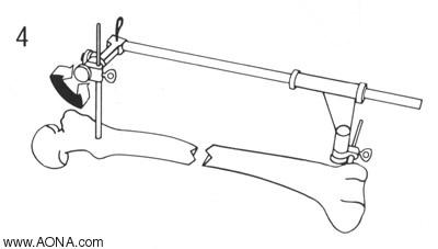 correct the angulation using the manipulation nail