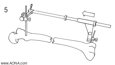 correct the angulation using the manipulation nail