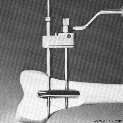 Make a stab incision over the distal hole