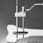 Make a stab incision over the distal hole