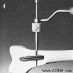 Resume with step 6 for distal locking technique