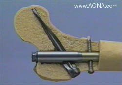 Femur:  Unreamed Femoral Nail System, Spiral Blade and Miss-A-Nail