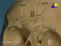 Fixation of Frontal Bone
 Fractures