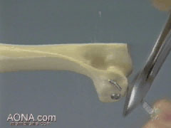 Interfragmentary Compression Fixation of the Lateral Portion of the Humeral Condyle with a Lag Screw and an Anti-Rotation Pin
